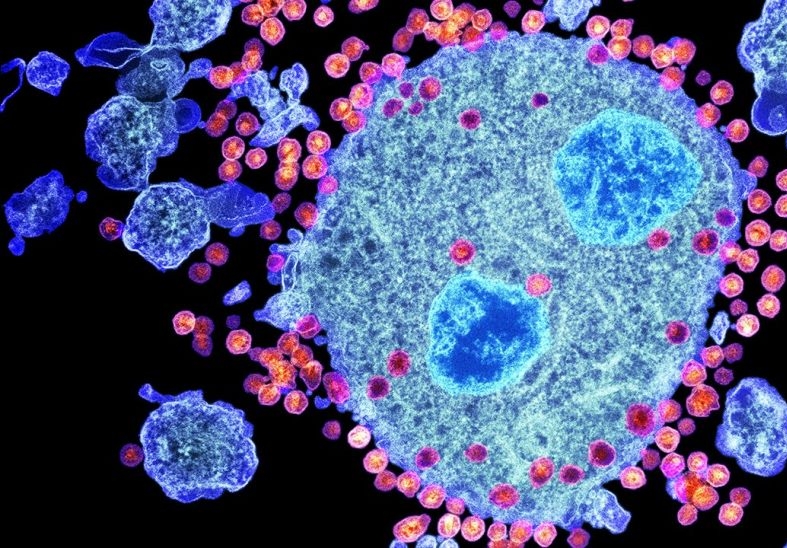 S-a găsit o modalitate de a distruge rezervele ascunse de HIV